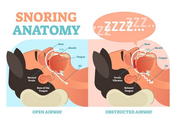 snoring anatomy